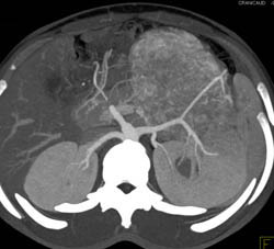 Unusual Renal Mass- RSNA Film Panel 2008 Diagnosis of Fibrous Tumor of the Kidney - CTisus CT Scan