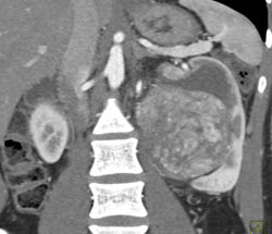 Unusual Renal Mass- RSNA Film Panel 2008 Diagnosis of Fibrous Tumor of the Kidney - CTisus CT Scan