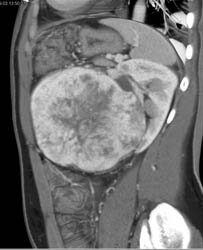 Unusual Renal Mass- RSNA Film Panel 2008 Diagnosis of Fibrous Tumor of the Kidney - CTisus CT Scan