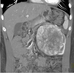 Unusual Renal Mass- RSNA Film Panel 2008 Diagnosis of Fibrous Tumor of the Kidney - CTisus CT Scan