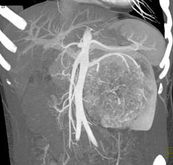 Unusual Renal Mass- RSNA Film Panel 2008 Diagnosis of Fibrous Tumor of the Kidney - CTisus CT Scan