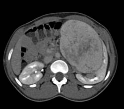 Unusual Renal Mass- RSNA Film Panel 2008 Diagnosis of Fibrous Tumor of the Kidney - CTisus CT Scan