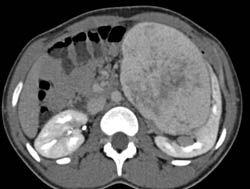 Unusual Renal Mass- RSNA Film Panel 2008 Diagnosis of Fibrous Tumor of the Kidney - CTisus CT Scan