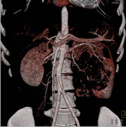 Unusual Renal Mass- RSNA Film Panel 2008 Diagnosis of Fibrous Tumor of the Kidney - CTisus CT Scan