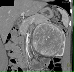 Unusual Renal Mass- RSNA Film Panel 2008 Diagnosis of Fibrous Tumor of the Kidney - CTisus CT Scan