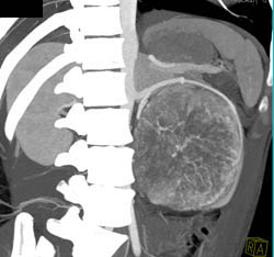 Unusual Renal Mass- RSNA Film Panel 2008 Diagnosis of Fibrous Tumor of the Kidney - CTisus CT Scan