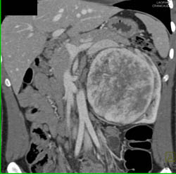 Unusual Renal Mass- RSNA Film Panel 2008 Diagnosis of Fibrous Tumor of the Kidney - CTisus CT Scan