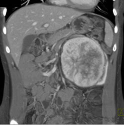 Unusual Renal Mass- RSNA Film Panel 2008 Diagnosis of Fibrous Tumor of the Kidney - CTisus CT Scan