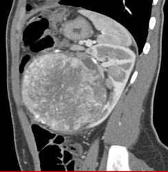 Unusual Renal Mass- RSNA Film Panel 2008 Diagnosis of Fibrous Tumor of the Kidney - CTisus CT Scan