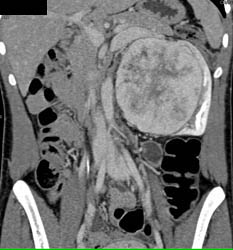 Unusual Renal Mass- RSNA Film Panel 2008 Diagnosis of Fibrous Tumor of the Kidney - CTisus CT Scan