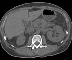 Sequence Shows Acute Pyelonephritis in the Left Kidney - CTisus CT Scan