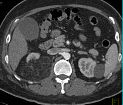 Renal Angiomyolipoma (AML) - CTisus CT Scan