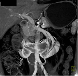 Horseshoe Kidney With Multiple Vessels Shown With MIP and VRT - CTisus CT Scan