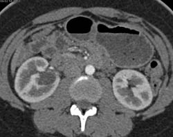 Complex Cyst Right Kidney Was A Dilated Calyx - CTisus CT Scan