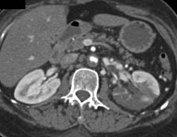 Renal Infarcts With Narrowed Aortic Lumen and Clot in Renal Artery and Celiac Artery - CTisus CT Scan