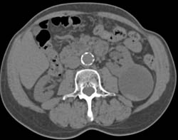 Renal Cancer in A Cyst- See Full Sequence of Images Especially Delayed Images - CTisus CT Scan