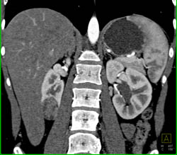 Renal Angiomyolipoma (AML) - CTisus CT Scan