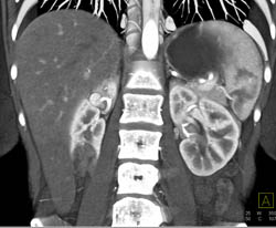 Renal Angiomyolipoma (AML) - CTisus CT Scan