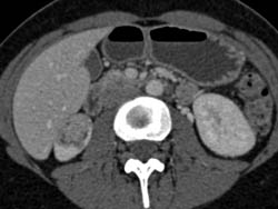 Renal Angiomyolipoma (AML) - CTisus CT Scan