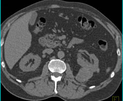High Density Renal Cyst - CTisus CT Scan