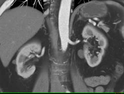 High Density Renal Cyst - CTisus CT Scan