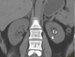 Renal Artery Aneurysm and Renal Calculi - CTisus CT Scan