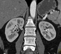 Renal Artery Aneurysm - CTisus CT Scan