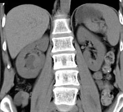 Cystic Renal Cell Carcinoma (RCC) - CTisus CT Scan