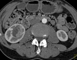 Cystic Renal Cell Carcinoma (RCC) - CTisus CT Scan