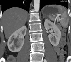 Cystic Renal Cell Carcinoma (RCC) - CTisus CT Scan