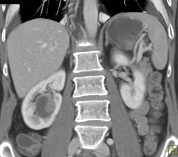 Cystic Renal Cell Carcinoma (RCC) - CTisus CT Scan