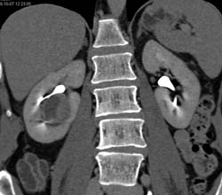 Cystic Renal Cell Carcinoma (RCC) - CTisus CT Scan