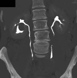 Cystic Renal Cell Carcinoma (RCC) - CTisus CT Scan