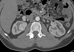 Cystic Renal Cell Carcinoma (RCC) - CTisus CT Scan