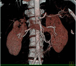 Renal Cell Carcinoma - CTisus CT Scan