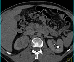 Renal Cell Carcinoma Upper Pole Right Kidney - CTisus CT Scan