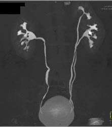 Duplicated Collecting System Down to Bladder - CTisus CT Scan