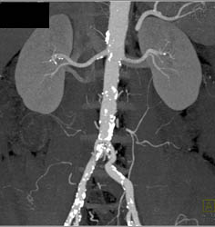 CTA of Renal Arteries With MIP - CTisus CT Scan