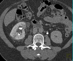 Dilated Right Ureter With Caliectasis - CTisus CT Scan