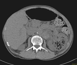 Necrotic Left Renal Tumor With Adenopathy - CTisus CT Scan