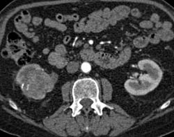 Transitional Cell Carcinoma - CTisus CT Scan