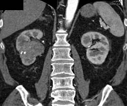 Transitional Cell Carcinoma - CTisus CT Scan