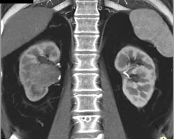 Transitional Cell Carcinoma - CTisus CT Scan