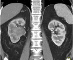 Transitional Cell Carcinoma - CTisus CT Scan