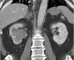 Transitional Cell Carcinoma - CTisus CT Scan