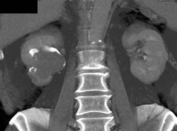 Transitional Cell Carcinoma - CTisus CT Scan