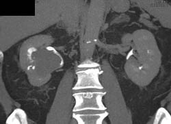 Transitional Cell Carcinoma - CTisus CT Scan