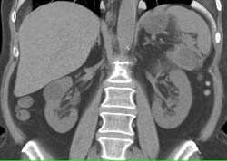 Cystic Mass Tail of Pancreas Simulates A Renal Cyst - CTisus CT Scan