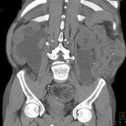 Dilated Renal Pelvis With Caliectasis and Neurogenic Bladder - CTisus CT Scan