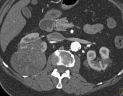 Cystic Renal Cell Carcinoma - CTisus CT Scan